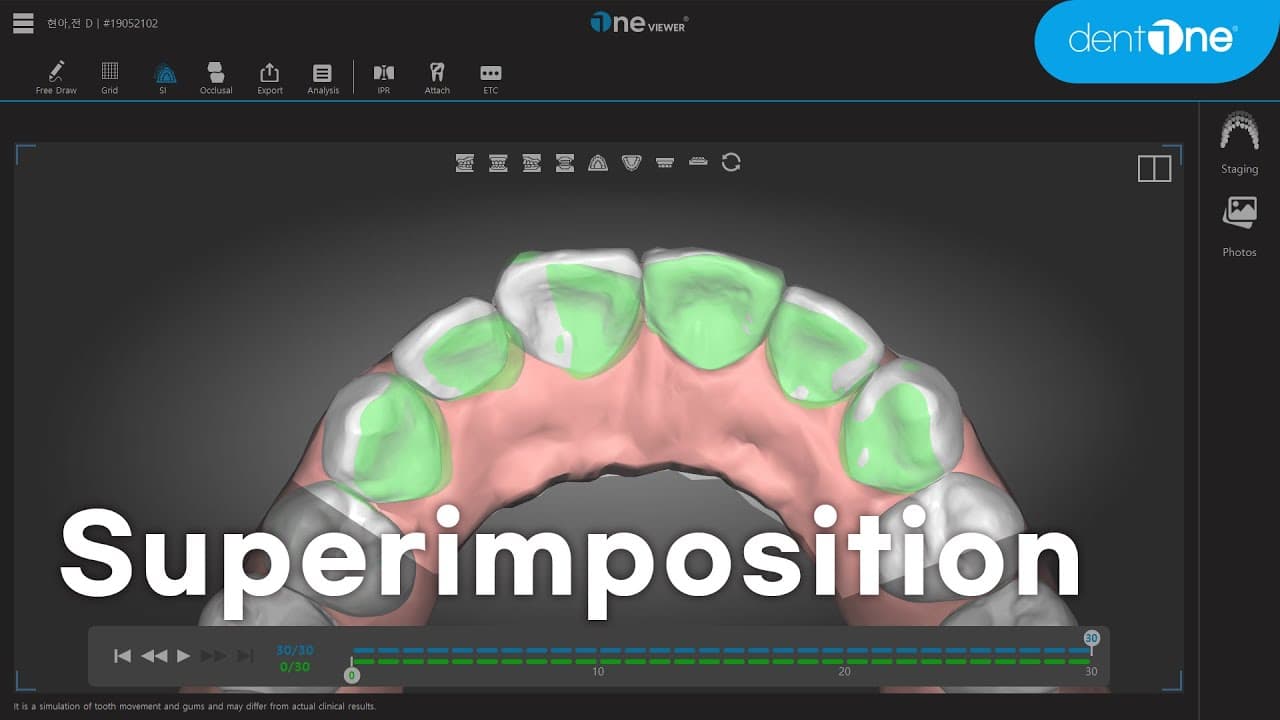 Superimposition