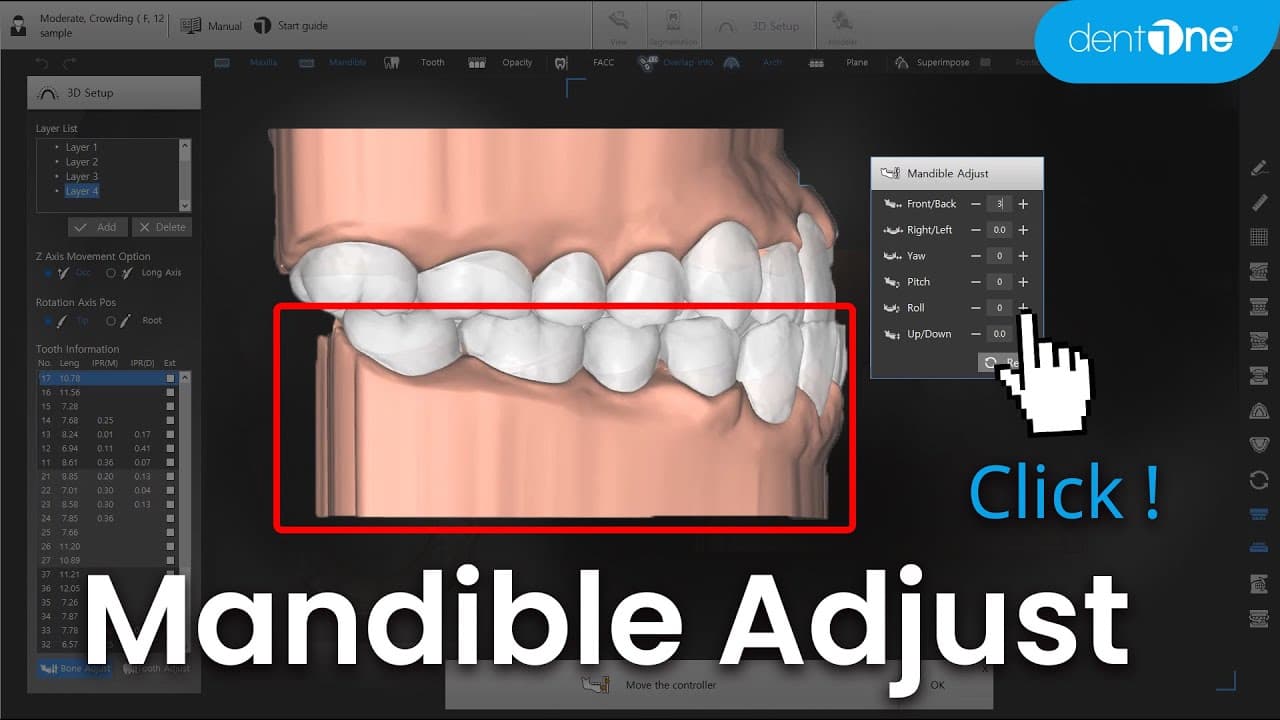 Mandible Adjust