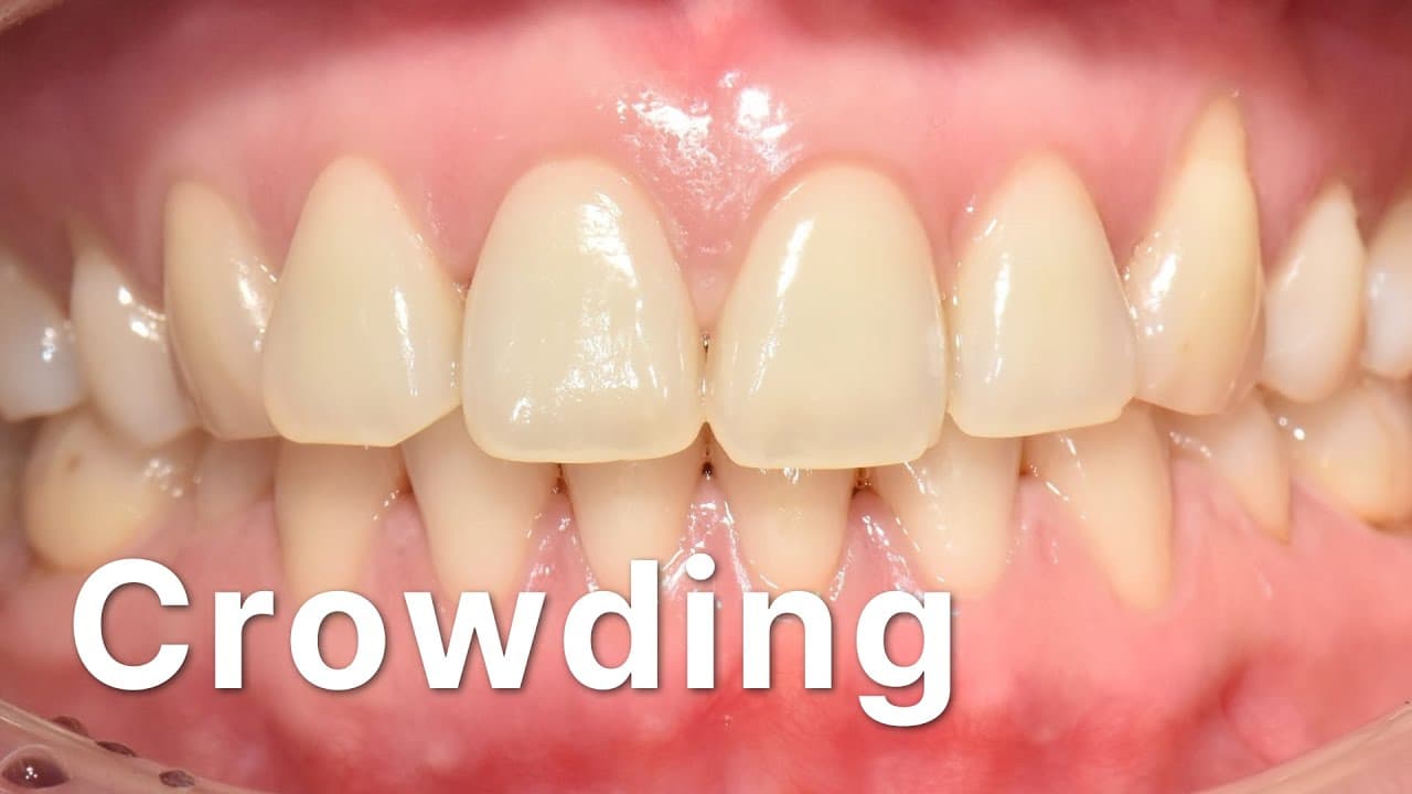 Crowding