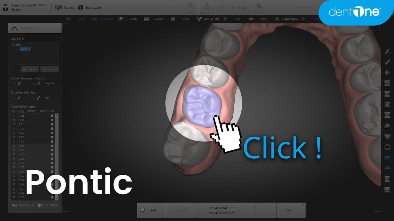 Pontic