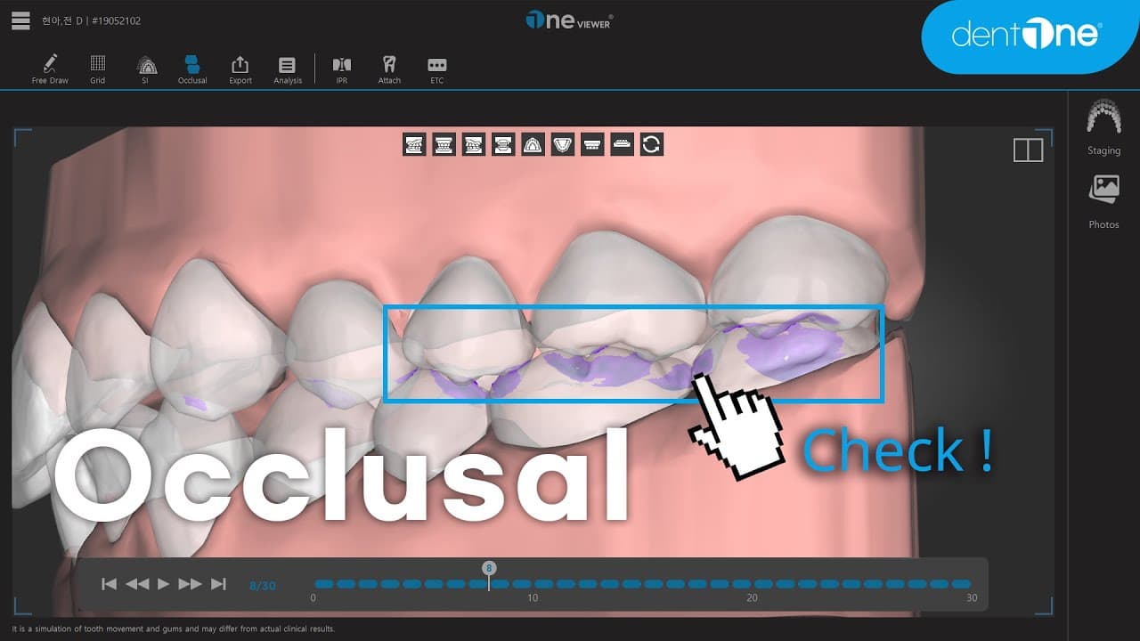 Occlusal