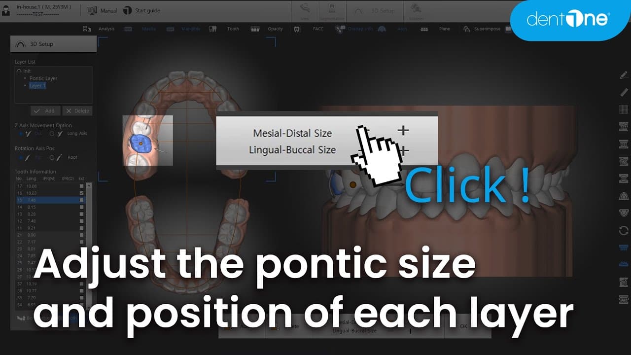 Pontic 크기 조절