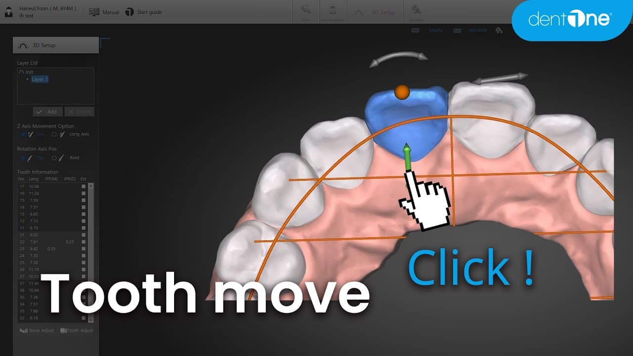 Tooth move