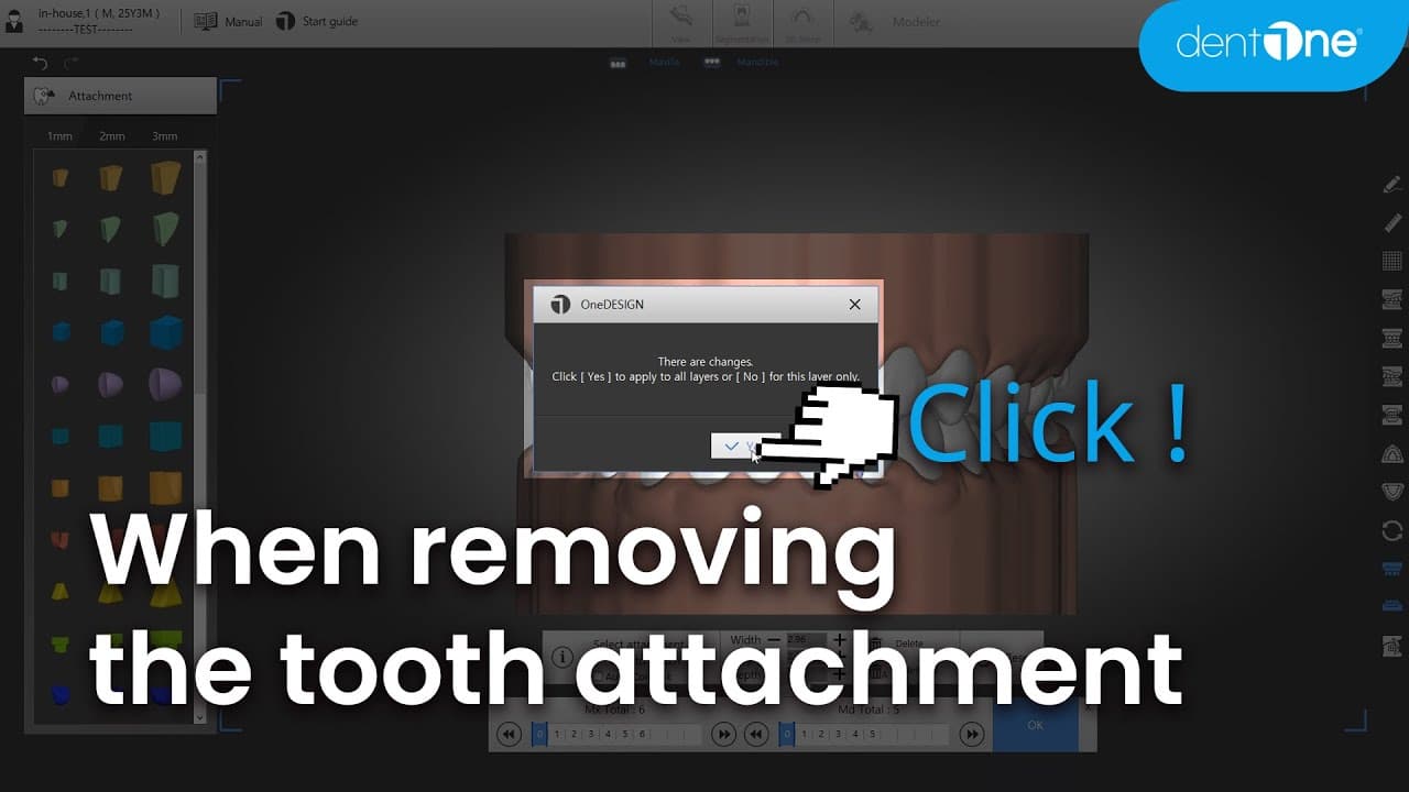 Attachment를 제거하는 경우