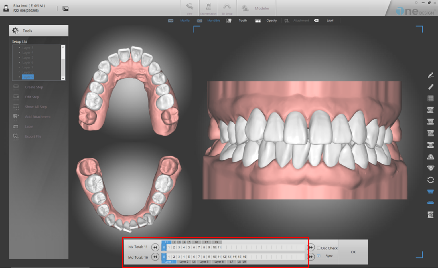 knowhow-design-dentone-clearaligner-3d-orthodontic-software